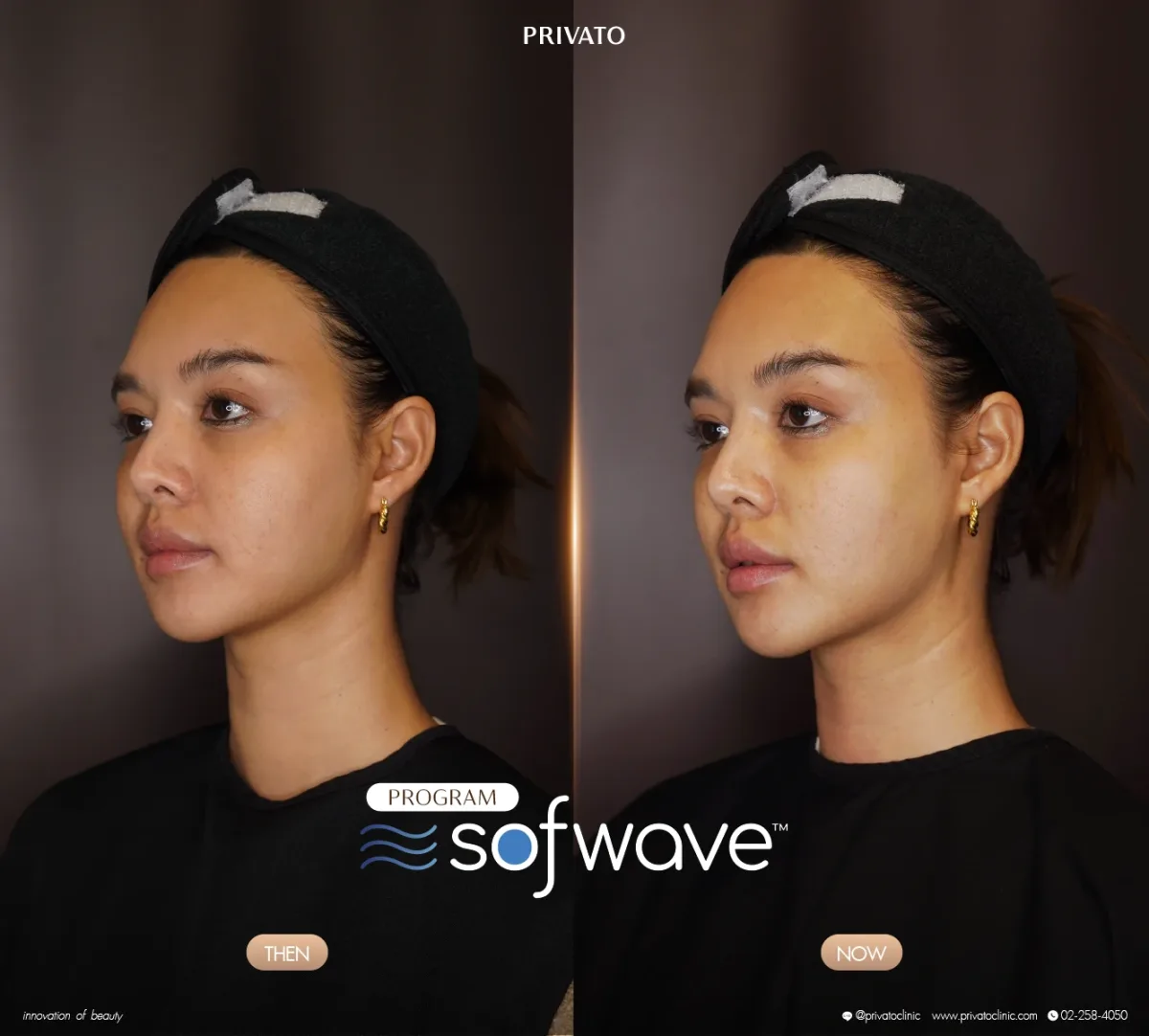 Sofwave before-and-after comparison of the face and jawline, angled view — photo 02.