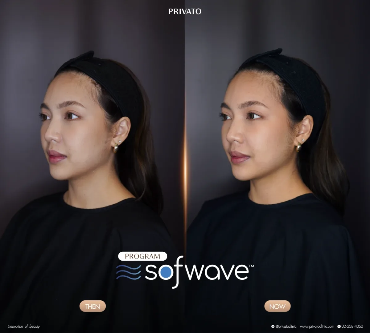 Sofwave before-and-after comparison of the face and jawline, angled view — photo 04.