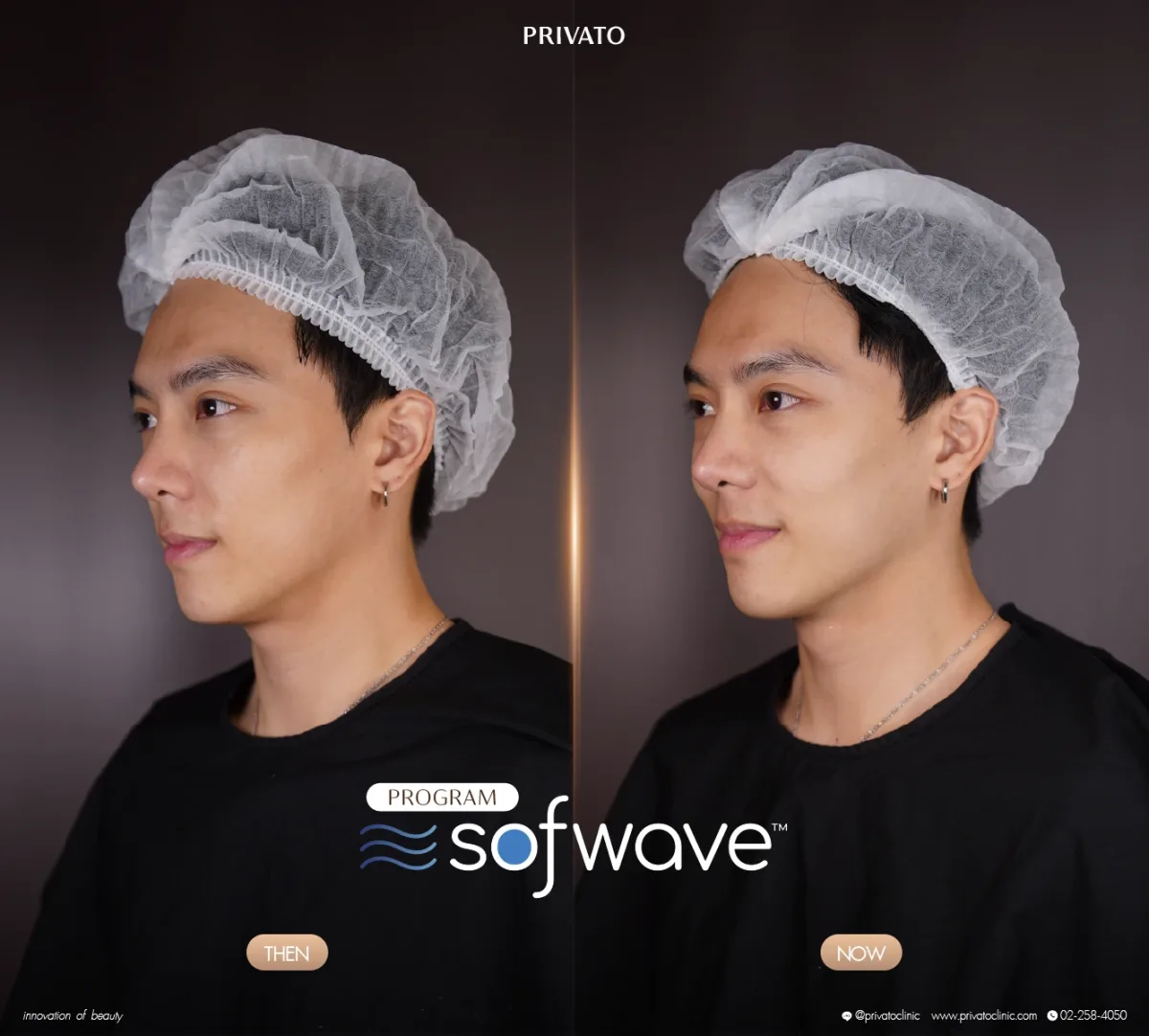 Sofwave before-and-after comparison of the face and jawline, angled view — photo 06.