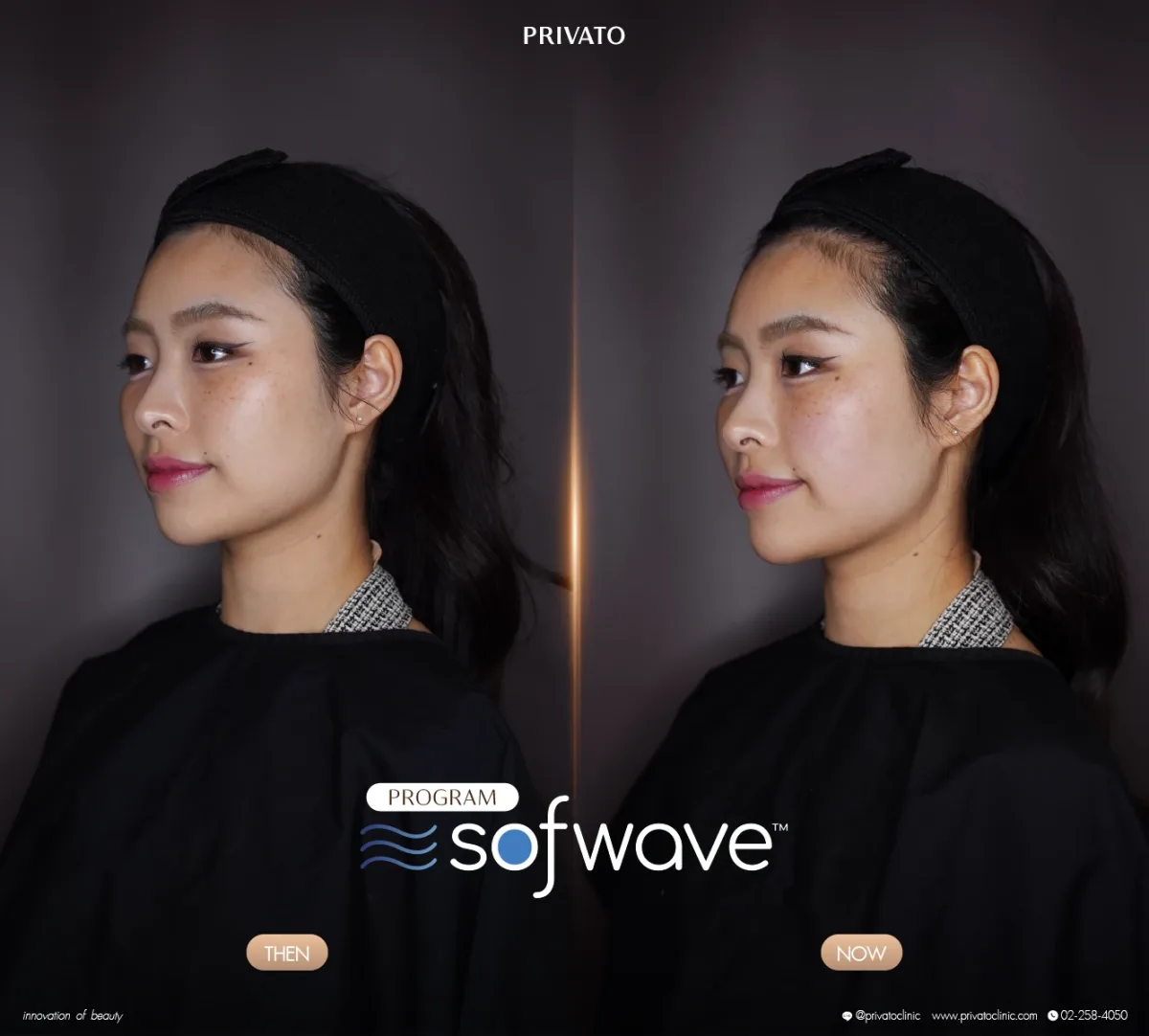 Sofwave before-and-after comparison of the face and jawline, angled view — photo 08.
