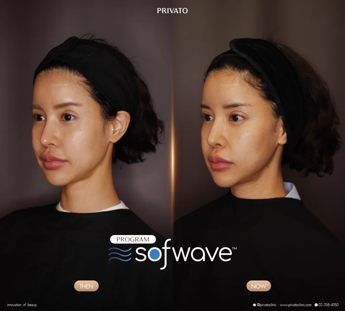 Sofwave before-and-after comparison of the face and jawline, angled view — photo 10.