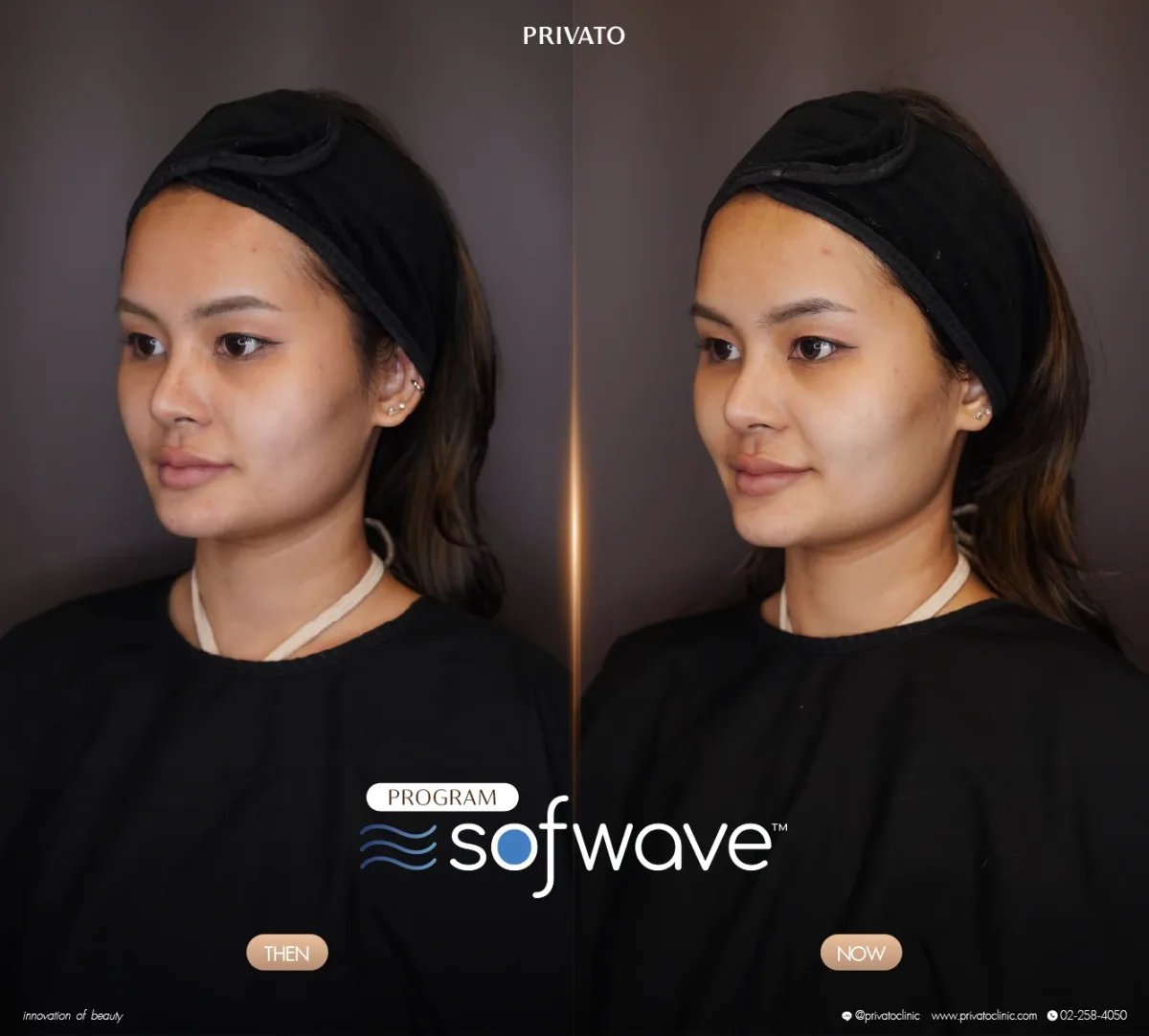 Sofwave before-and-after comparison of the face and jawline, angled view — photo 12.