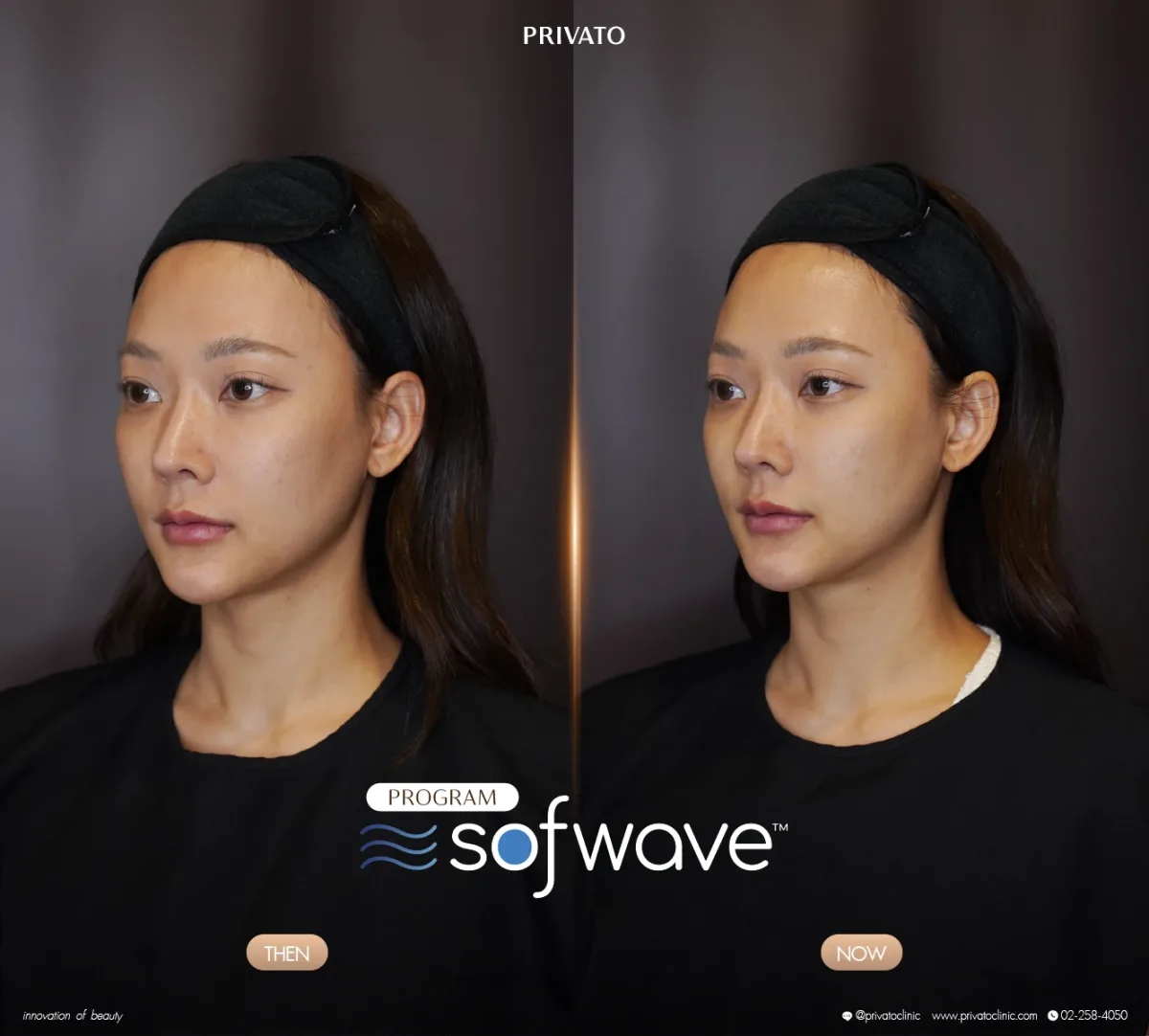 Sofwave before-and-after comparison of the face and jawline, angled view — photo 14.