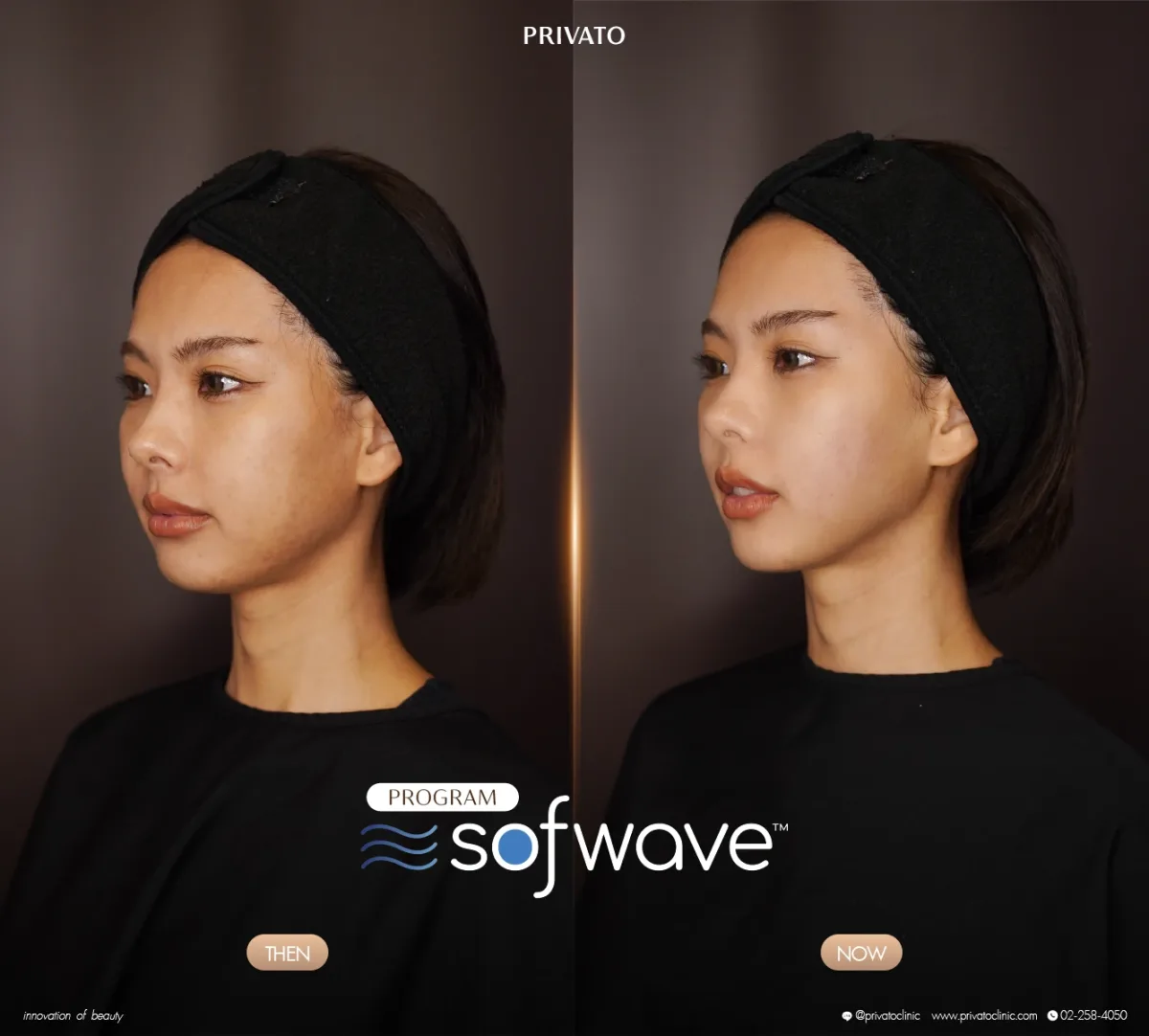 Sofwave before-and-after comparison of the face and jawline, angled view — photo 16.