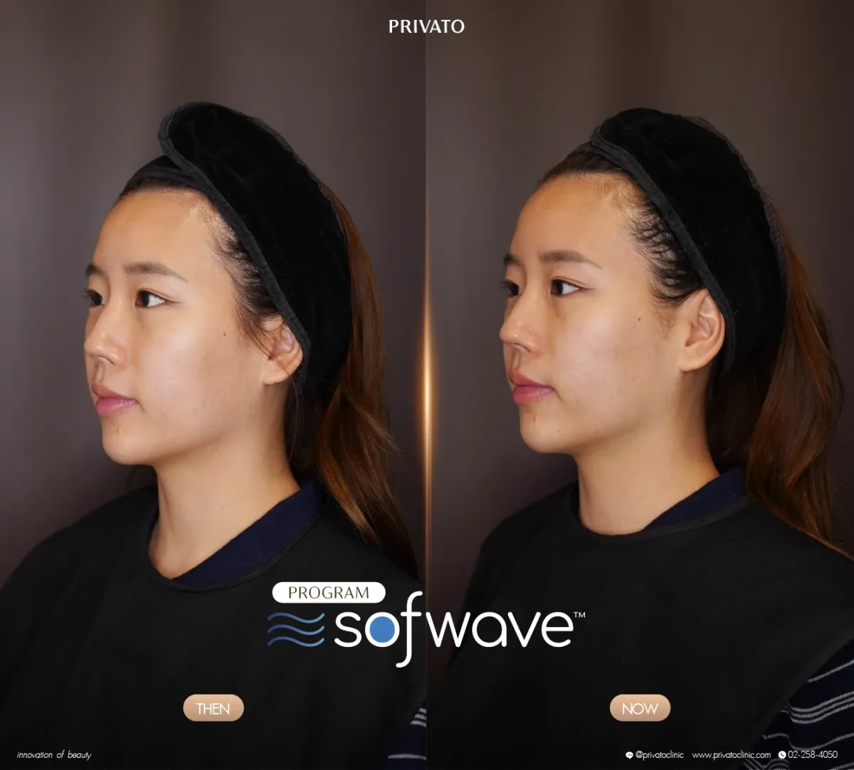 Sofwave before-and-after comparison of the face and jawline, angled view — photo 18.