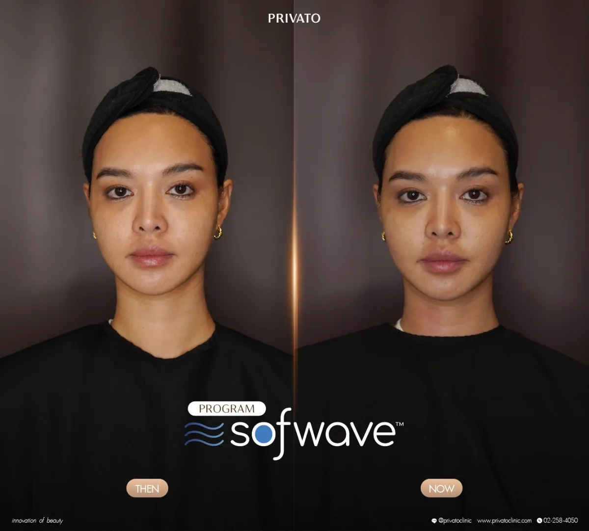 Sofwave before-and-after comparison of the face and jawline, front view — photo 01.