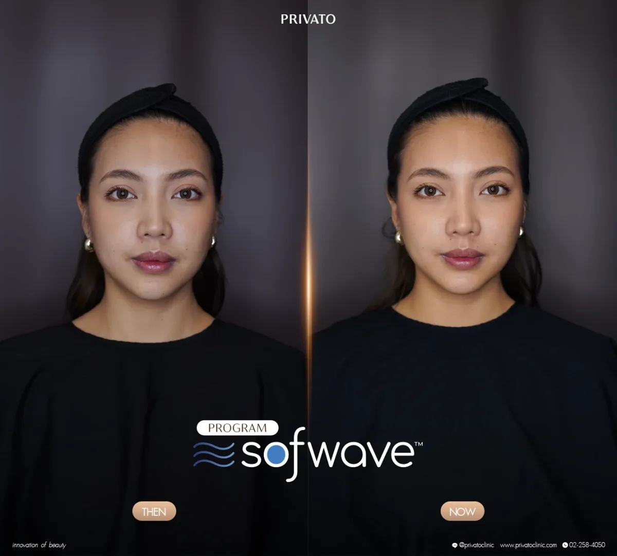 Sofwave before-and-after comparison of the face and jawline, front view — photo 03.