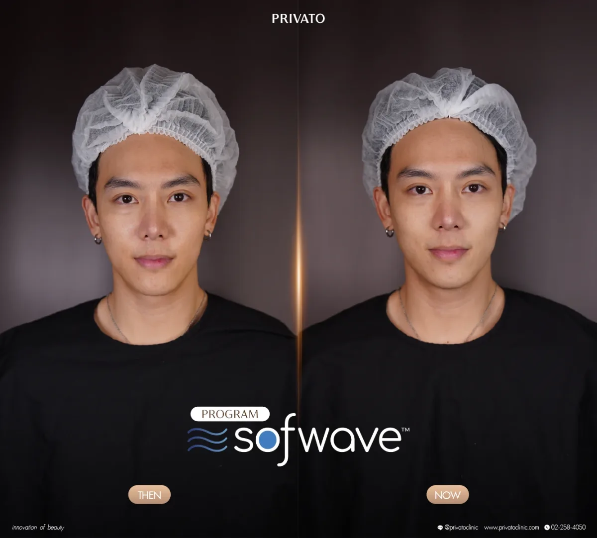 Sofwave before-and-after comparison of the face and jawline, front view — photo 05.