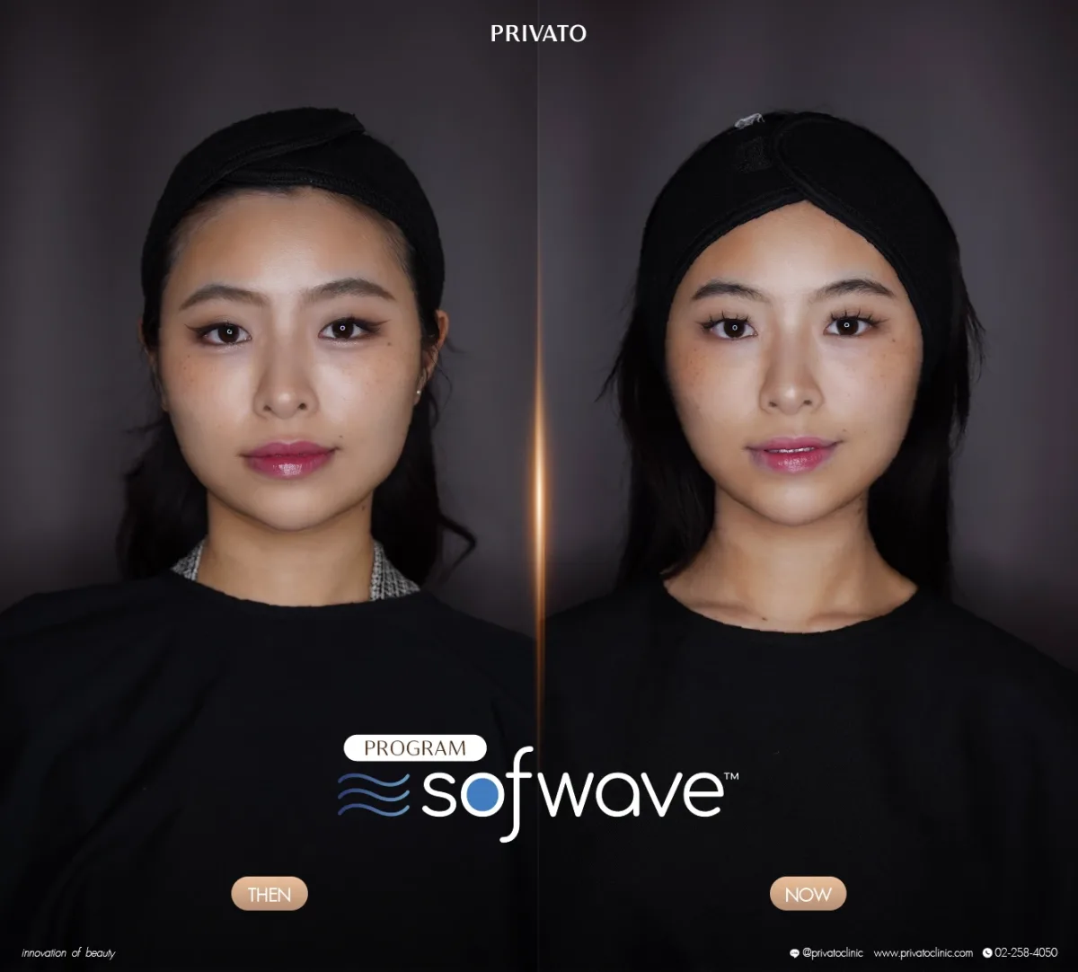 Sofwave before-and-after comparison of the face and jawline, front view — photo 07.