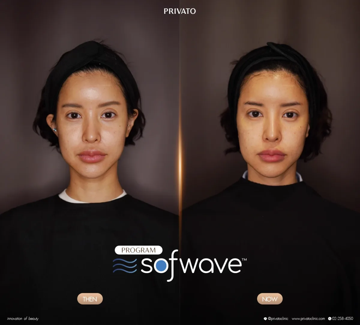 Sofwave before-and-after comparison of the face and jawline, front view — photo 09.