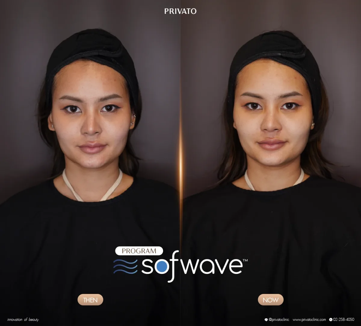 Sofwave before-and-after comparison of the face and jawline, front view — photo 11.