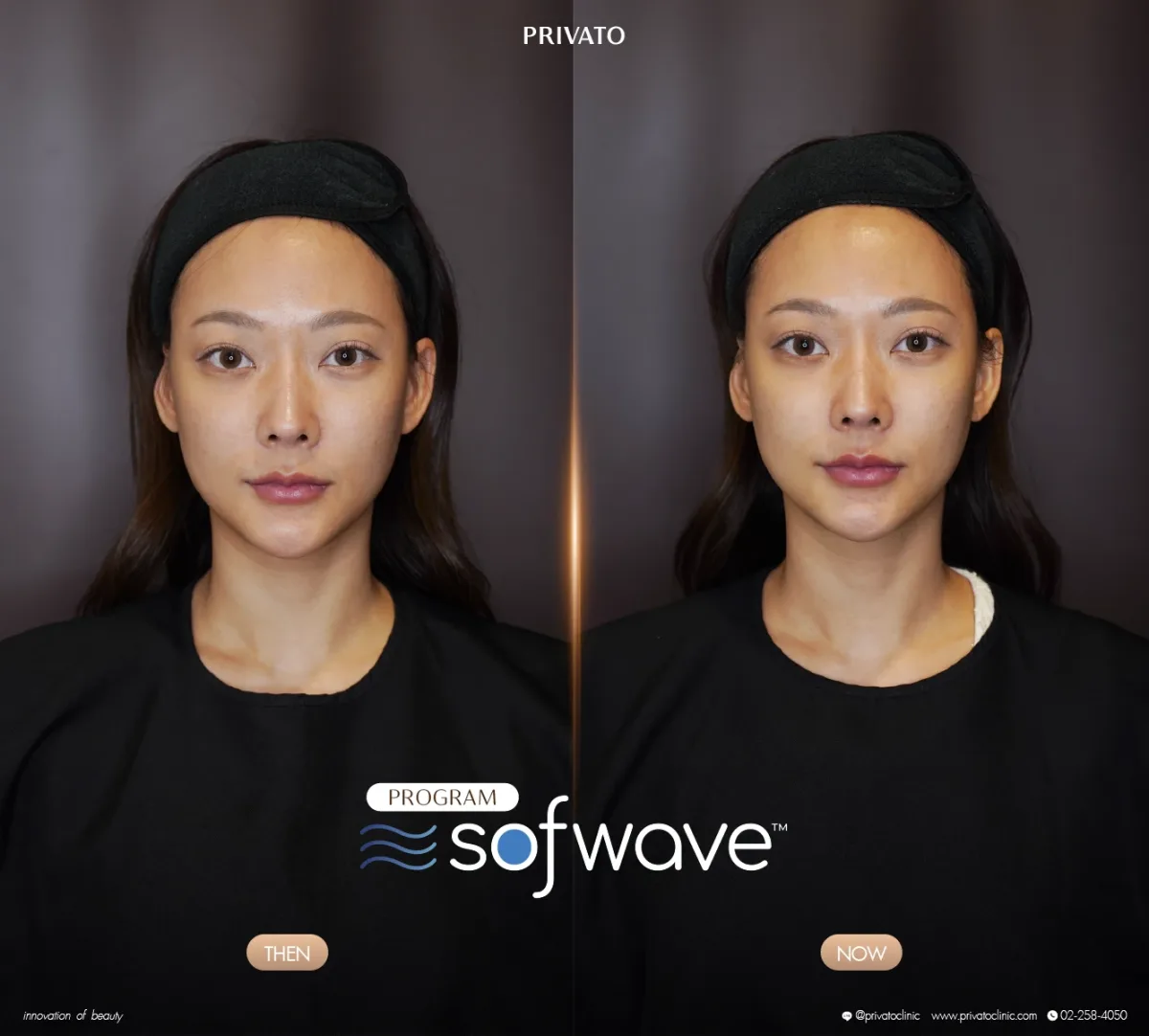 Sofwave before-and-after comparison of the face and jawline, front view — photo 13.