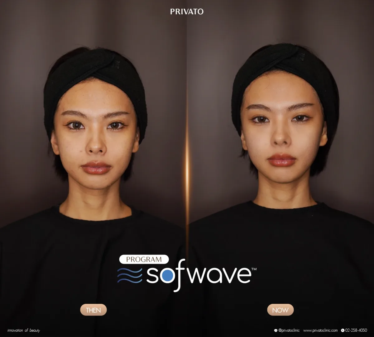 Sofwave before-and-after comparison of the face and jawline, front view — photo 15.