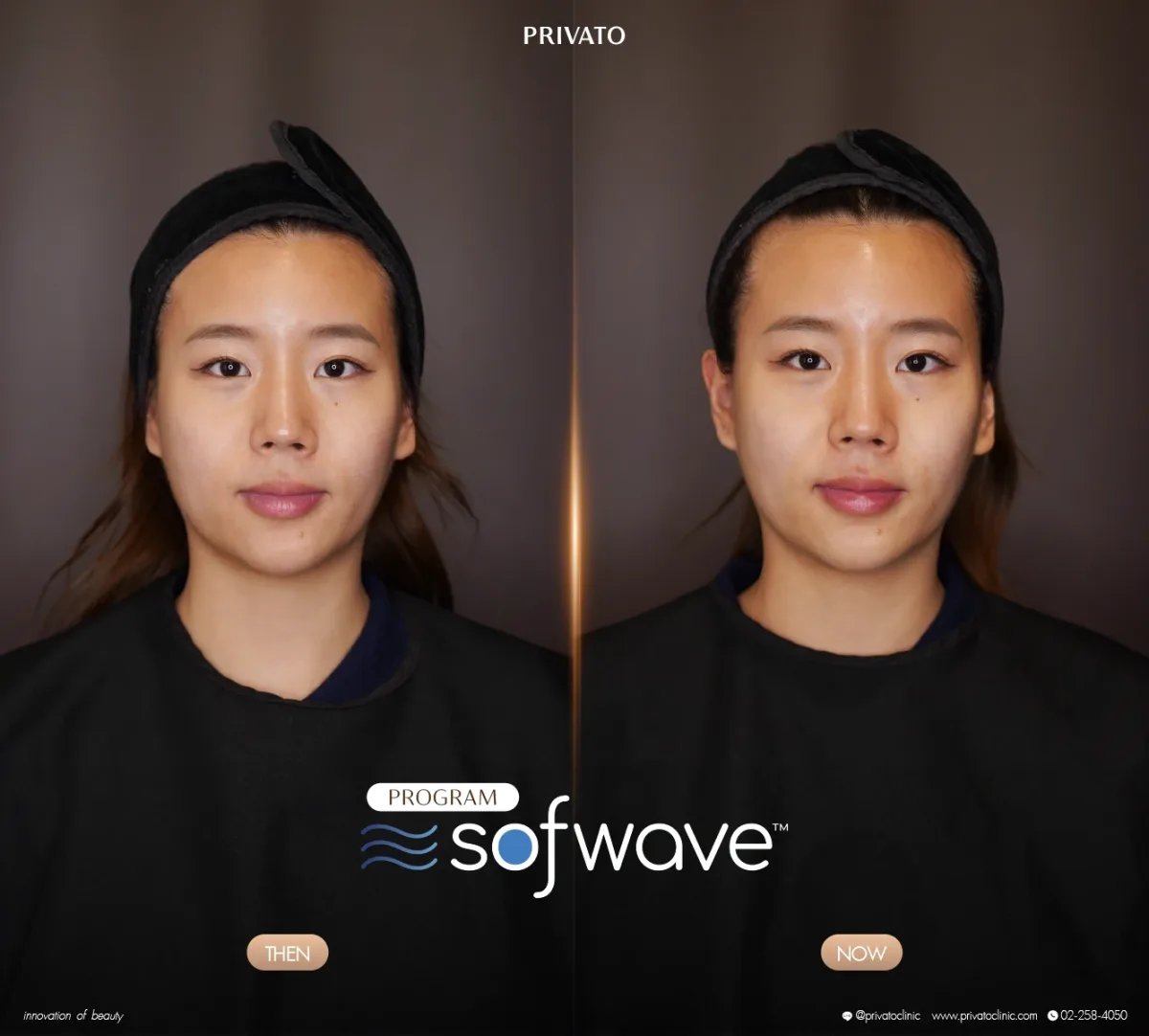 Sofwave before-and-after comparison of the face and jawline, front view — photo 17.